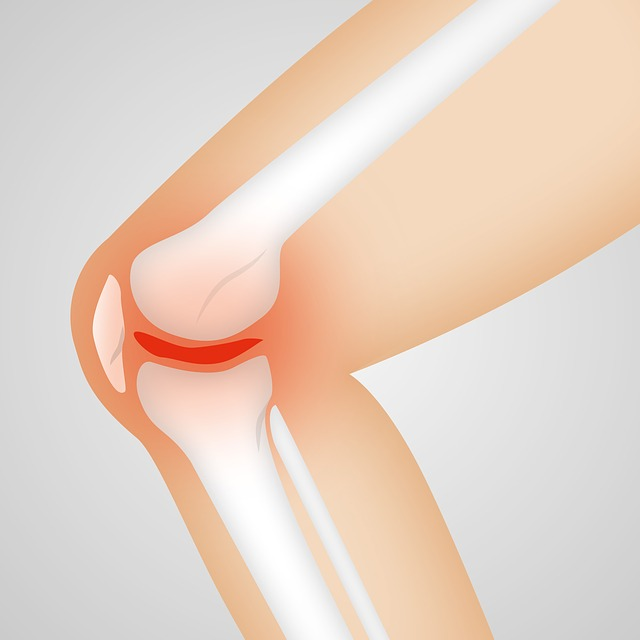 Tout savoir sur la Chondropathie du genou